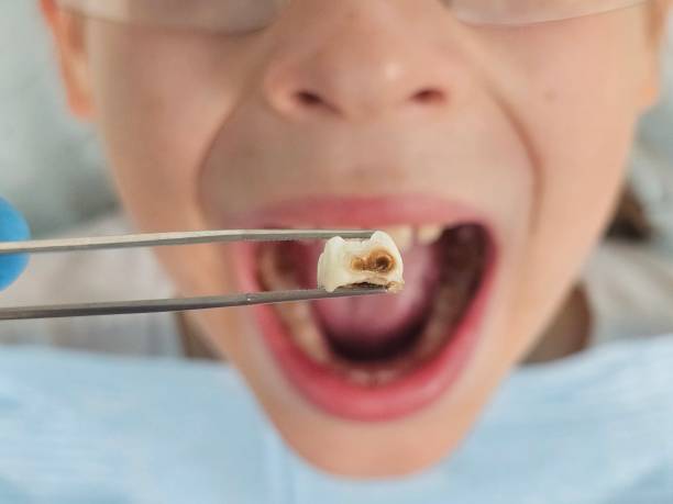 Best Emergency Dental Care for Abscessed Tooth in New Egypt, NJ